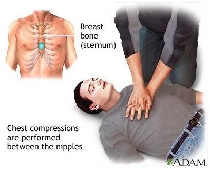 CPR - chest compressions