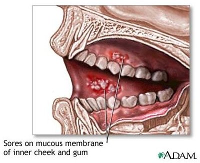 Learn about Natural Healing for Mouth Sores Caused by Chemotherapy