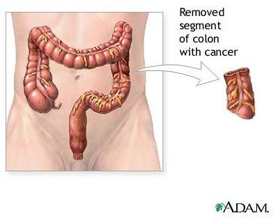 Learn about Laser Treatment for Colon Cancer