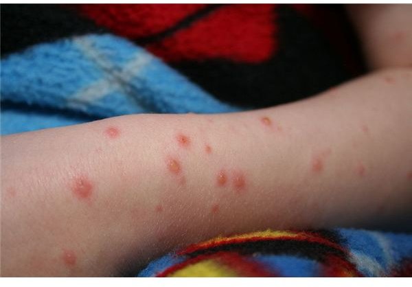 Chicken Pox Vaccine Reactions and Other Essential Information