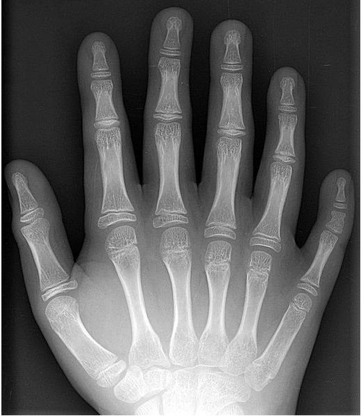 How is Polydactyly Inherited?