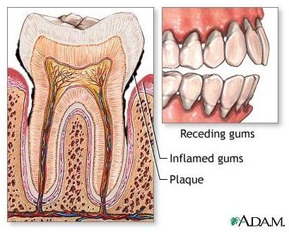Find Natural Remedies for Periodontal Disease