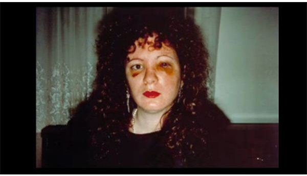 Nan Goldin Bruised