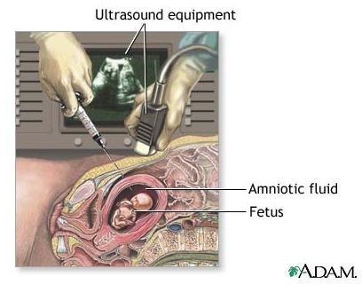 Amniocentesis Pros and Cons