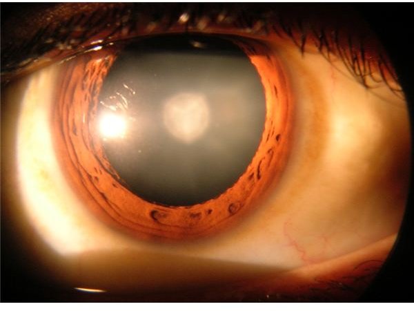 Cataract Surgery Recovery Time: The Surgery, Follow-Up Care and Healing