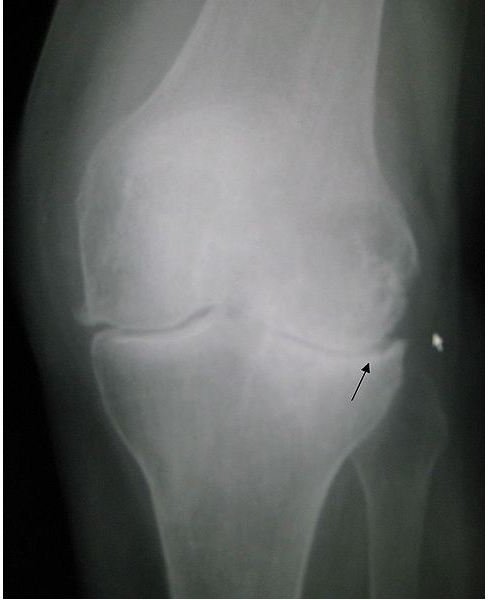 Osteoarthritis of the left knee. Note the osteophytes, narrowing of the joint space (arrow), and increased subchondral bone density (arrow).