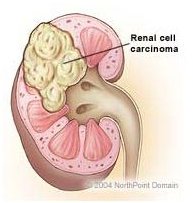 Knowing the Early Symptoms of Kidney Cancer