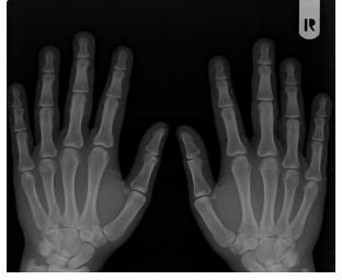 Landmark Rheumatoid Arthritis Clinical Trials: Its Early Identification to New Directions in Treating and Understanding Rheumatoid Arthritis