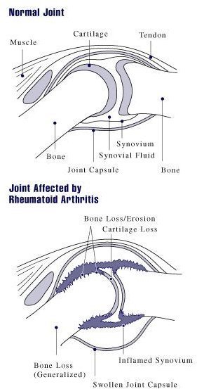 Comparing normal joint to joint with arthritis.
