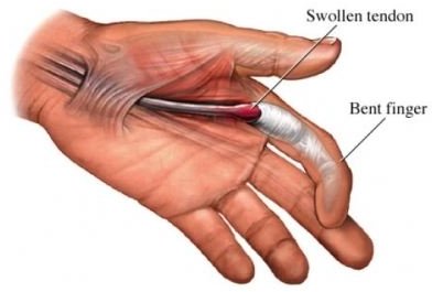 Treatment for Trigger Finger: Treating Mild to Severe Cases
