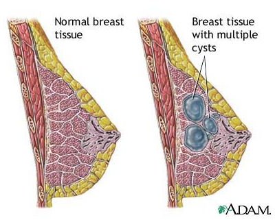 What is Fibrocystic Breast Disease?