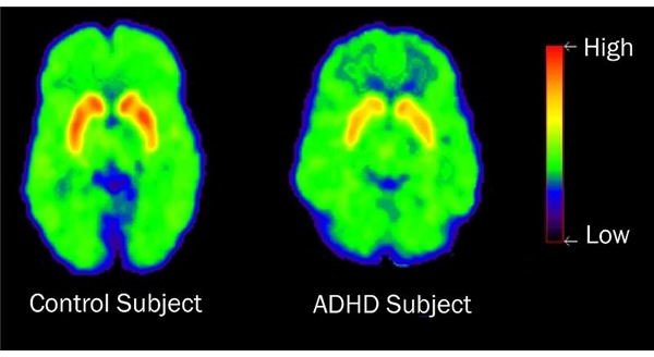 Is ADHD Genetic? New Facts Question the Relation