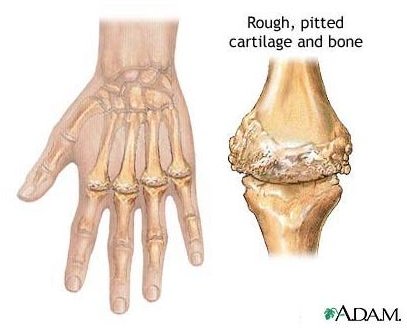 Natural Treatment for Rheumatoid Arthritis