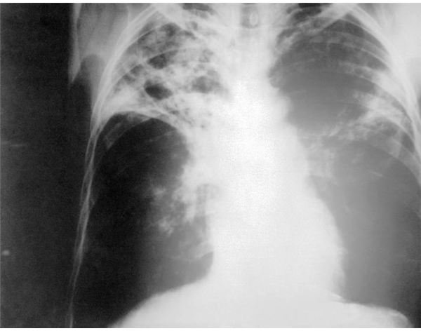 Complications of Pulmonary Tuberculosis