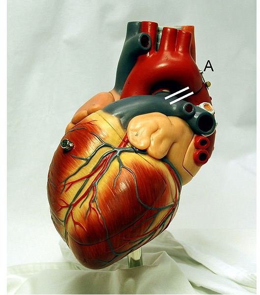 Relationship Between Pulmonary Hypertension and Congestive Heart Failure