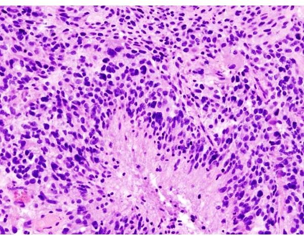 Glioblastoma Multiforme Causes: A Look at Genes that Could Cause Glioblastoma Multiforme