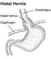 What Is an Esophageal Hernia?