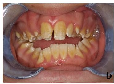 Amelogenesis Imperfecta: A Rare Genetic Disorder That Causes Bad Teeth
