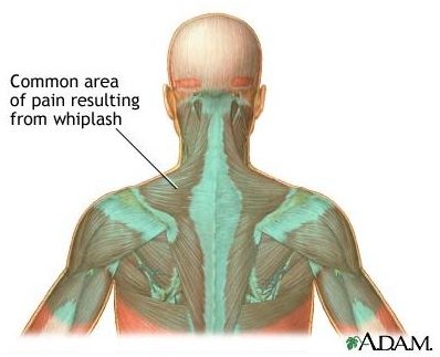 Whiplash Pain