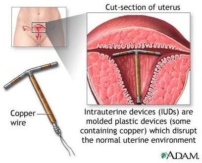 Intrauterine Device: IUD Information