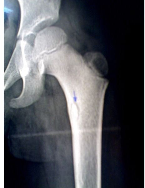 450px-Bony sequestrum in a child femur