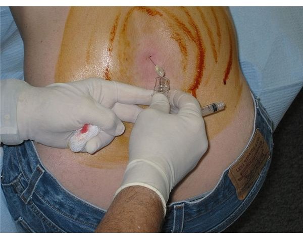 Lumbar Puncture Procedure Guide