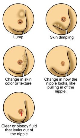 En Breast cancer illustrations