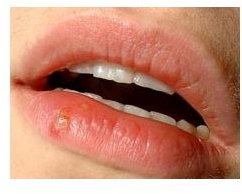 Cold Sore Treatments That Work