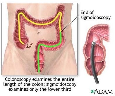 Preparing for a Colonoscopy