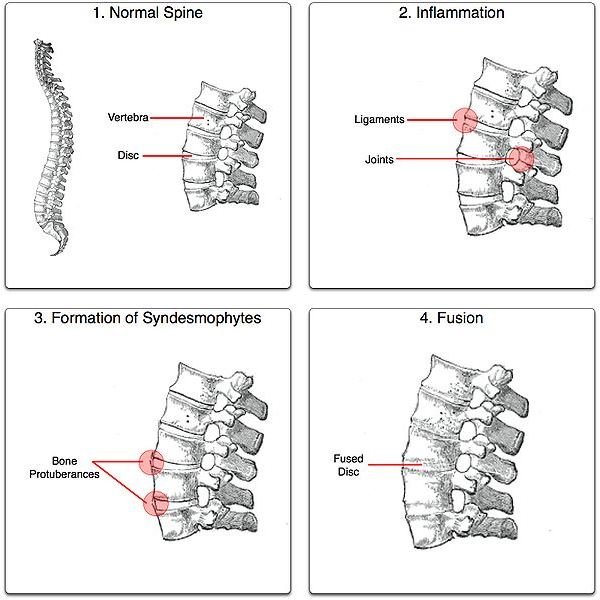 Learn the Symptoms of Ankylosing Spondylitis in Children