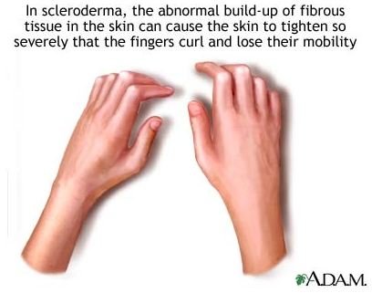 Alternative Medicine: Scleroderma Natural Treatments