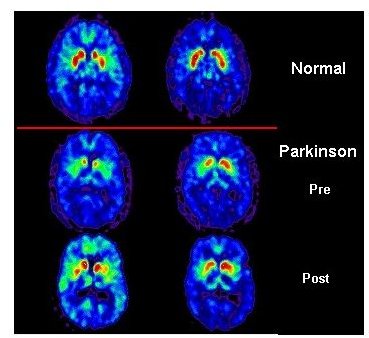 What is a PET Scan? Positron Emission Tomography