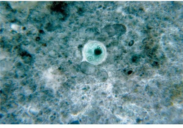 Entamoeba Histolytica Infection - Caused by Amebic Dysentery